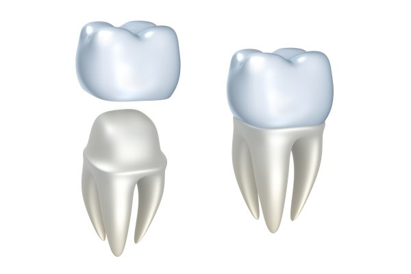 How Long Does It Take To Get Implant Crowns?