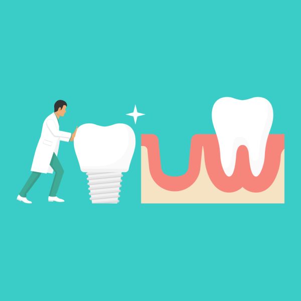 How Long Do Dental Implants Take To Heal?